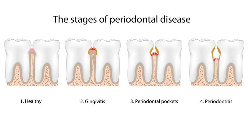 gum-disease-stages