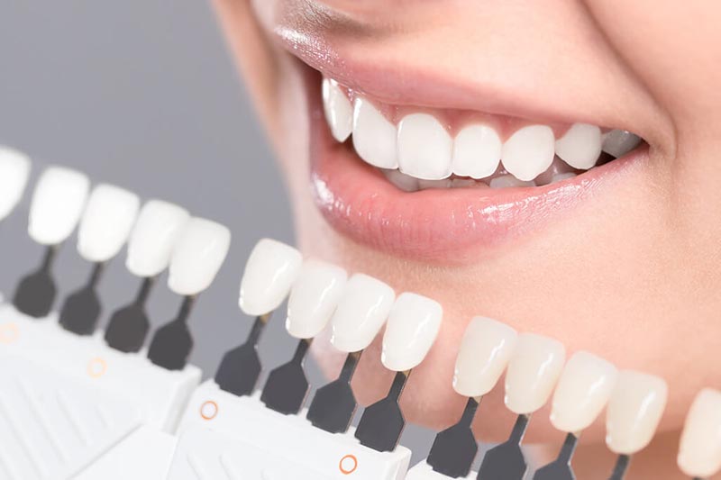 dental-whitening