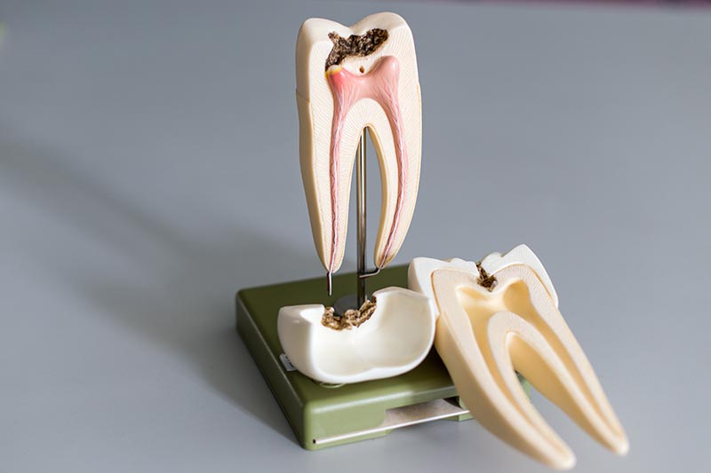 Root Canal Therapy | Treatment, Pain Management, and More